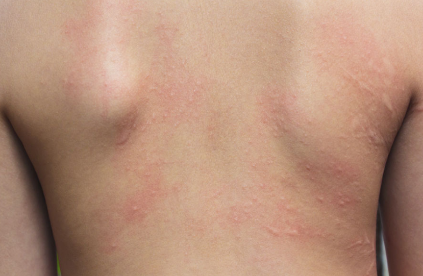 تاثیر آب آلوده بر پوست بدن