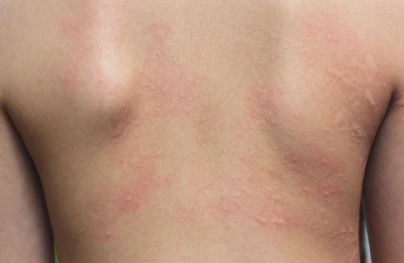 تاثیر آب آلوده بر پوست بدن